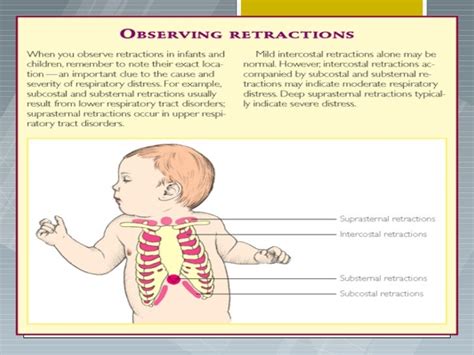 Respiratory Disorders Peds