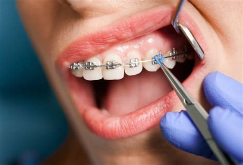 Stained Teeth After Braces Snow® Oral Care