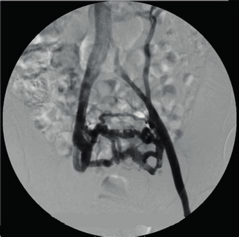 Phlebography Showing A Dilated Left Ovarian Vein And Other Prominent