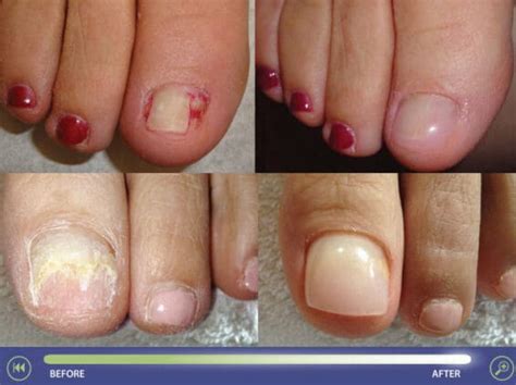 Preventing Corns And Calluses The Fresh Foot Centre