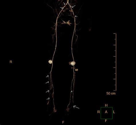 3D reconstruction showing extensive aortoiliac atherosclerosis ...