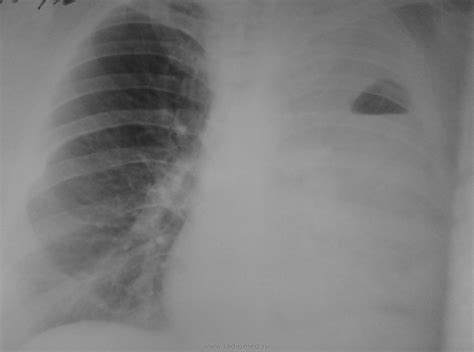 Грудная клетка | Портал радиологов