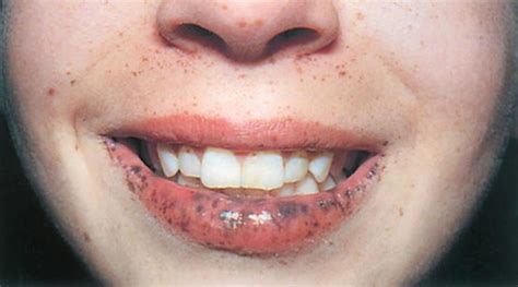 peutz jeghers syndrome  symptoms diagnosis treatment