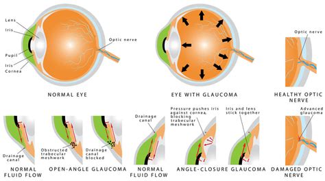 What Are The Types Of Glaucoma Michigan Glaucoma And Cataract