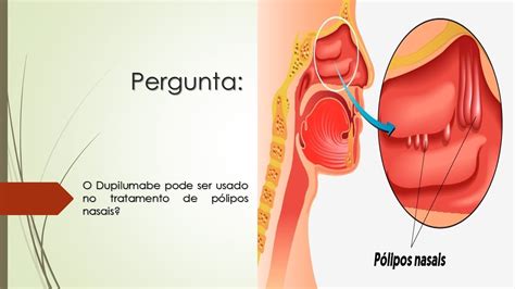 P Lipos Nasais O Dupilumabe Dupixent Pode Ser Usado No Tratamento