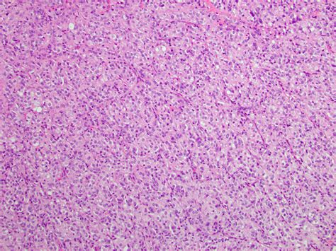 Pathology Outlines GIST