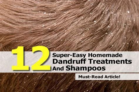 12 Homemade Dandruff Treatments And Shampoos Anti Aging Beauty Health And Personal Care