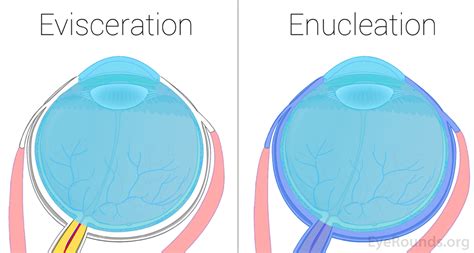 Enucleation And Evisceration What To Expect