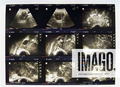 Uterus Fibroid Ultrasound Pelvic Ultrasound Analysis And Result On Image N