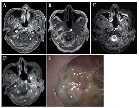 Clinical And Imaging Characteristics Of 53 Ulcers Of Postradiation