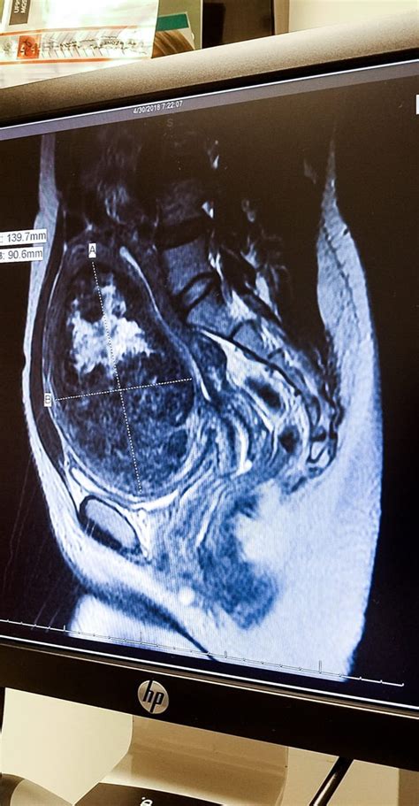 My Fibroid Story: From Start to Almost Finish - Laparoscopic Myomectomy