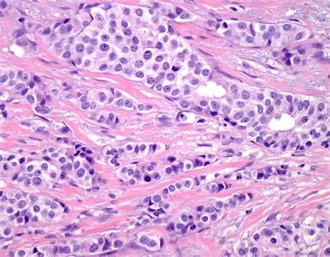 Invasive Ductal Carcinoma Stages