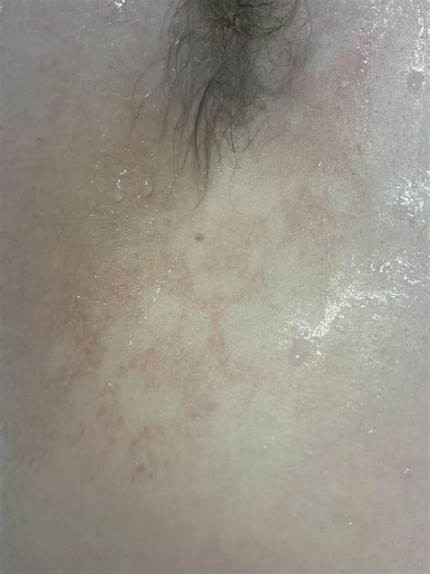 Odd speckled rash under arms and inside of forearms. : r