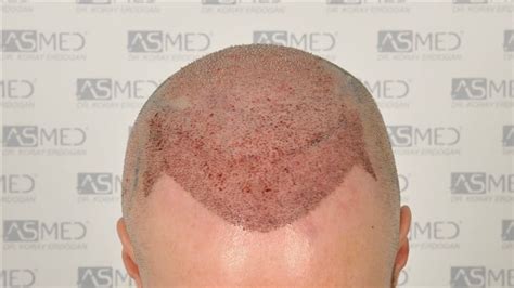 5007 Grafts Fue Norwood 6 Asmed Hair Transplant Results