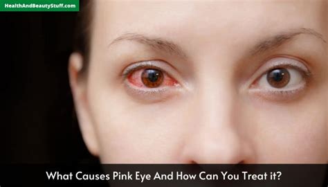 What Causes Pink Eye And How Can You Treat It?