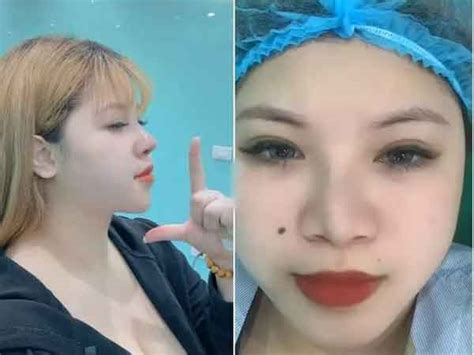 Hết hút lít mỡ hot girl ngực khủng lại dao kéo mặt tiền