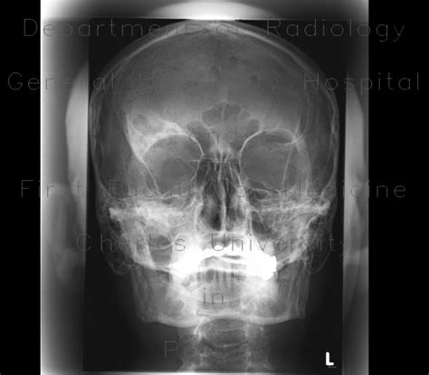 Radiology Case Fibrous Dysplasia Of Frontal Bone