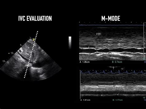 Inferior Vena Cava Alberta Sono