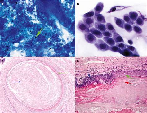 Trichoepithelioma In Dogs