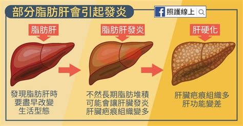 照護線上》脂肪堆積很傷肝，保肝護肝看這裡！（懶人包） 自由評論網