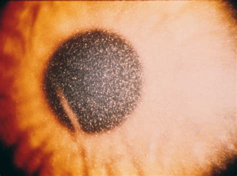 Cystinosis causes, types, symptoms, diagnosis & treatment