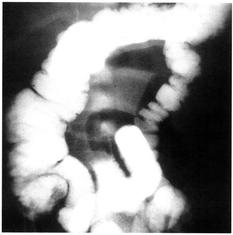 Ileoileal Intussusception A Report Of Four Cases Annals Of Saudi Medicine