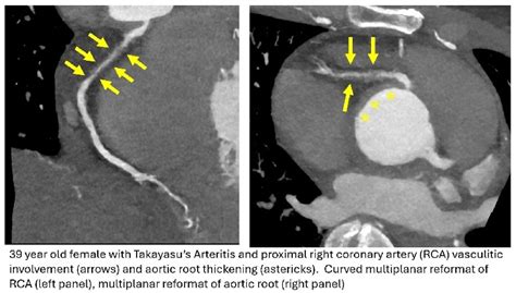 coronary artery involvement  takayasus arteritis journal