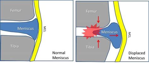 Meniscus Root Tear Sun Orthopaedic