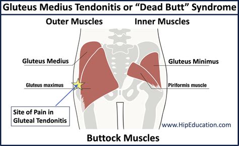 gluteus medius tendonitis gluteal tendinopathy  dead butt syndrome
