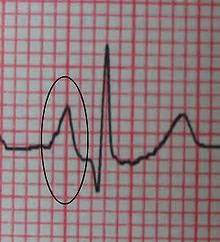 By Request, P wave morphology and what it tells us! | 12LEADEKG