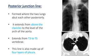 Radioanatomy of mediastinum and approach to mediastinal masses | PPTX