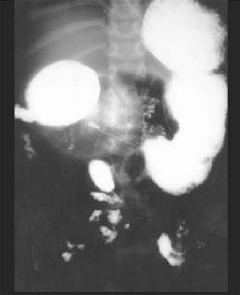 upper gastrointestinal study showing  dilated duodenum