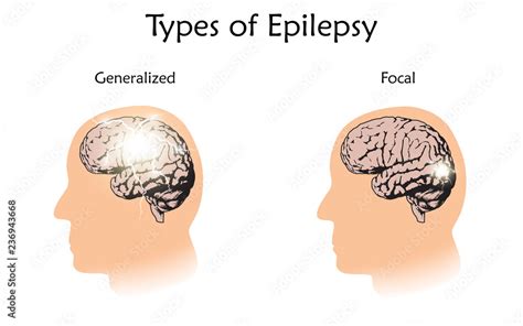 Epilepsy Brain Diagram