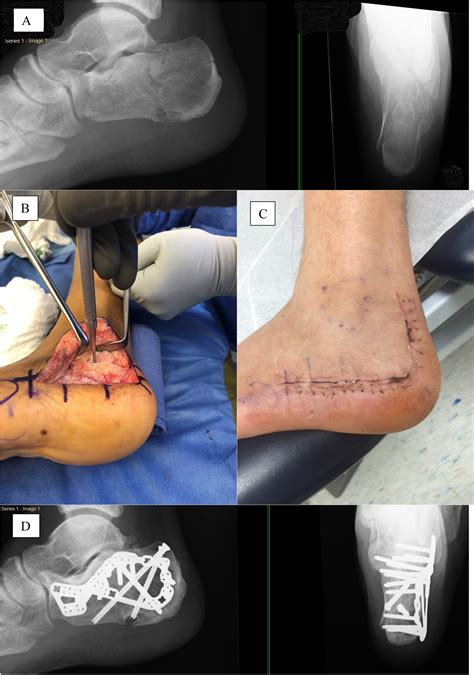 Fixation of displaced intra-articular calcaneus fractures is safe using