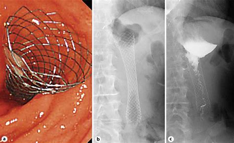 Figure 2 From Wallflex™ Duodenal Stent Placement In A Gastric Cancer Patient With Malignant