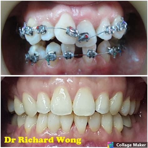 Missing Lower Incisors Dr Richard Wong Dental Surgery