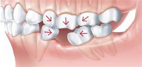 5 Problems That A Missing Tooth Can Create