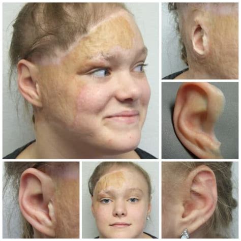 Auricular Photo Gallery Medical Art Prosthetics