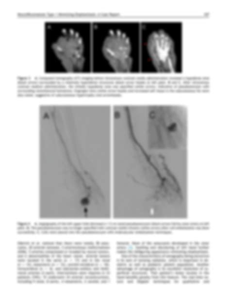 Solution Left Ulnar Artery Pseudoaneurysm And Left Hand Swelling