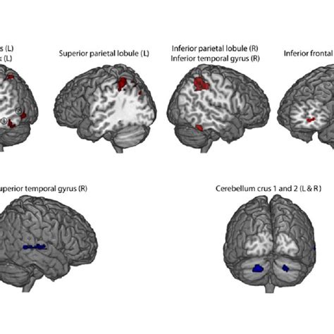 Results From The Voxel To Voxel Analysis Showing Areas Of Highest Download Scientific Diagram