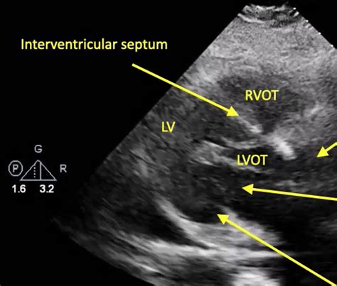 Point Of Care Ultrasound Evaluation Of Pericardial Effusion Part 2