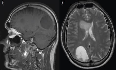 Glioblastoma Multiforme Modern Optometry