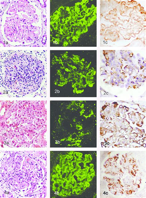 A Panel Of Representative Cases Of Glomerular Diseases Light