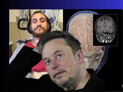 Primer Humano Con Un Chip En Su Cerebro ¿cómo Funciona Y Cuál Es El Objetivo Del Plan De Elon