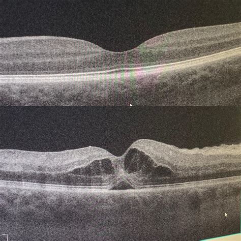 My BRVO... normal eye is like a nice sand dune, bad eye looks like a