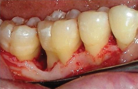 Following Incision A Full Thickness Mucoperiosteal Flap Was Reflected