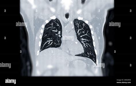 Ctpa Or Cta Pulmonary Artery This Imaging Technique Offers A Clear