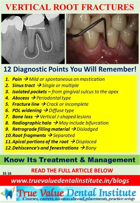 Vertical Root Fractures True Value Dental