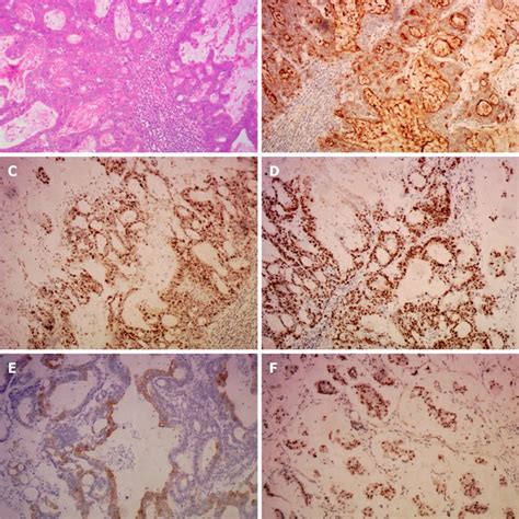 The Pathological Examination Of The Cervical Lymph Node The Download Scientific Diagram