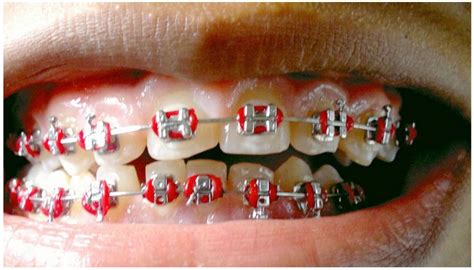 Цветные резинки на брекеты